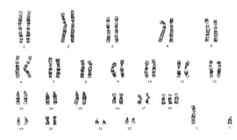 Cariotip_3_cromozomi_in_perechea_18