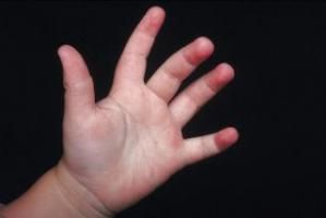 Degeraturi la bebelusi, prevenire si tratament