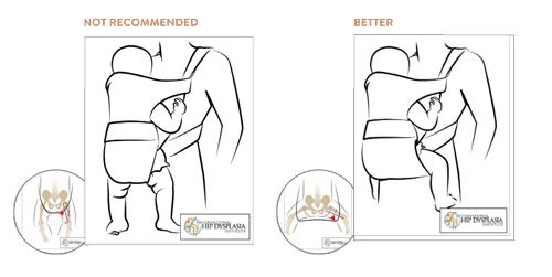HIP-DYSPLASIA-STATEMENT