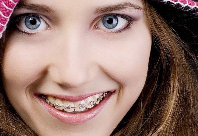 University student Turns into Panther Adolescentul – cand si de care tip de aparat dentar are nevoie? | Copilul.ro