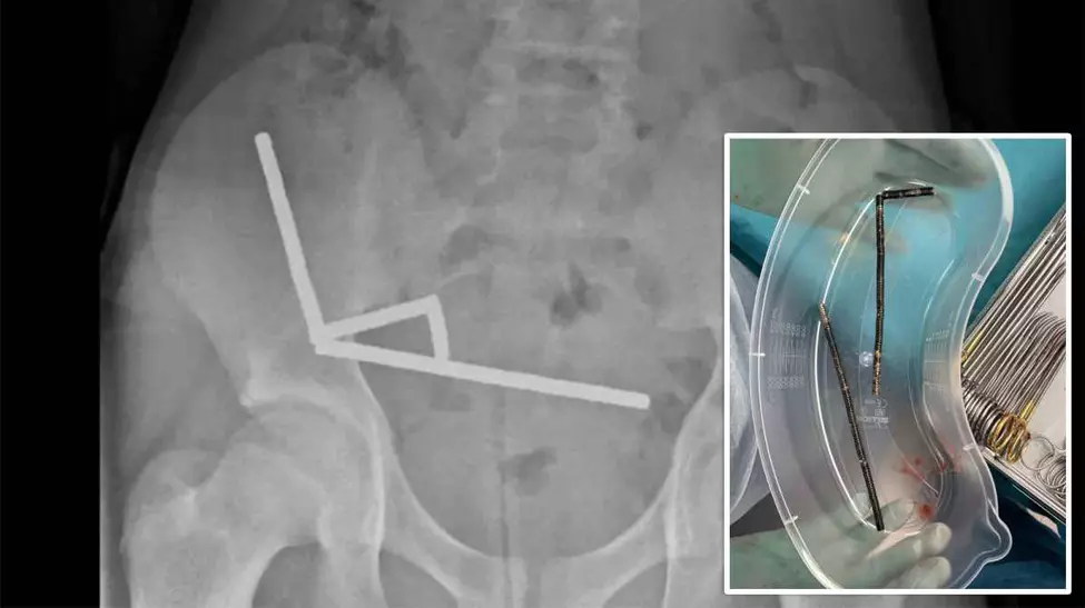 Baiat de 13 ani, operat de urgenta dupa ce a inghitit aproape 100 de magneti cumparati de pe Temu