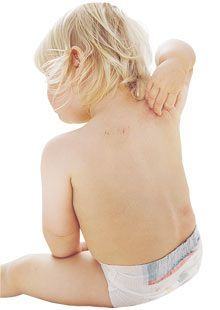Micoză de piele la copii